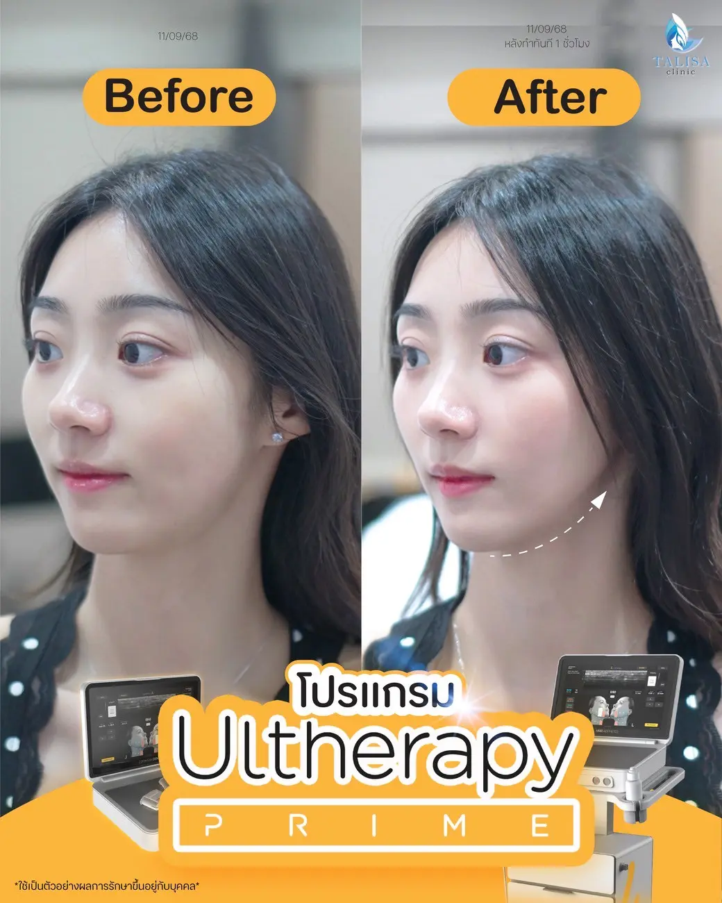 โปรแกรม Ulthera Prime