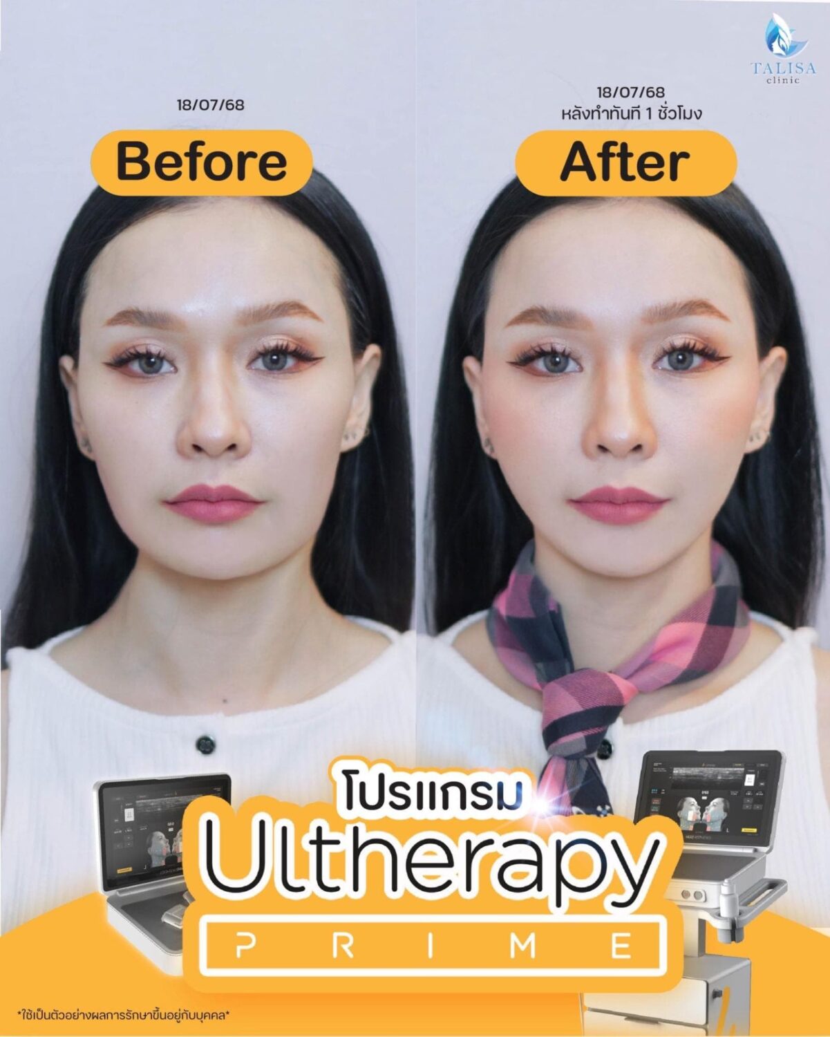 Ulthera Prime กี่วันเห็นผล