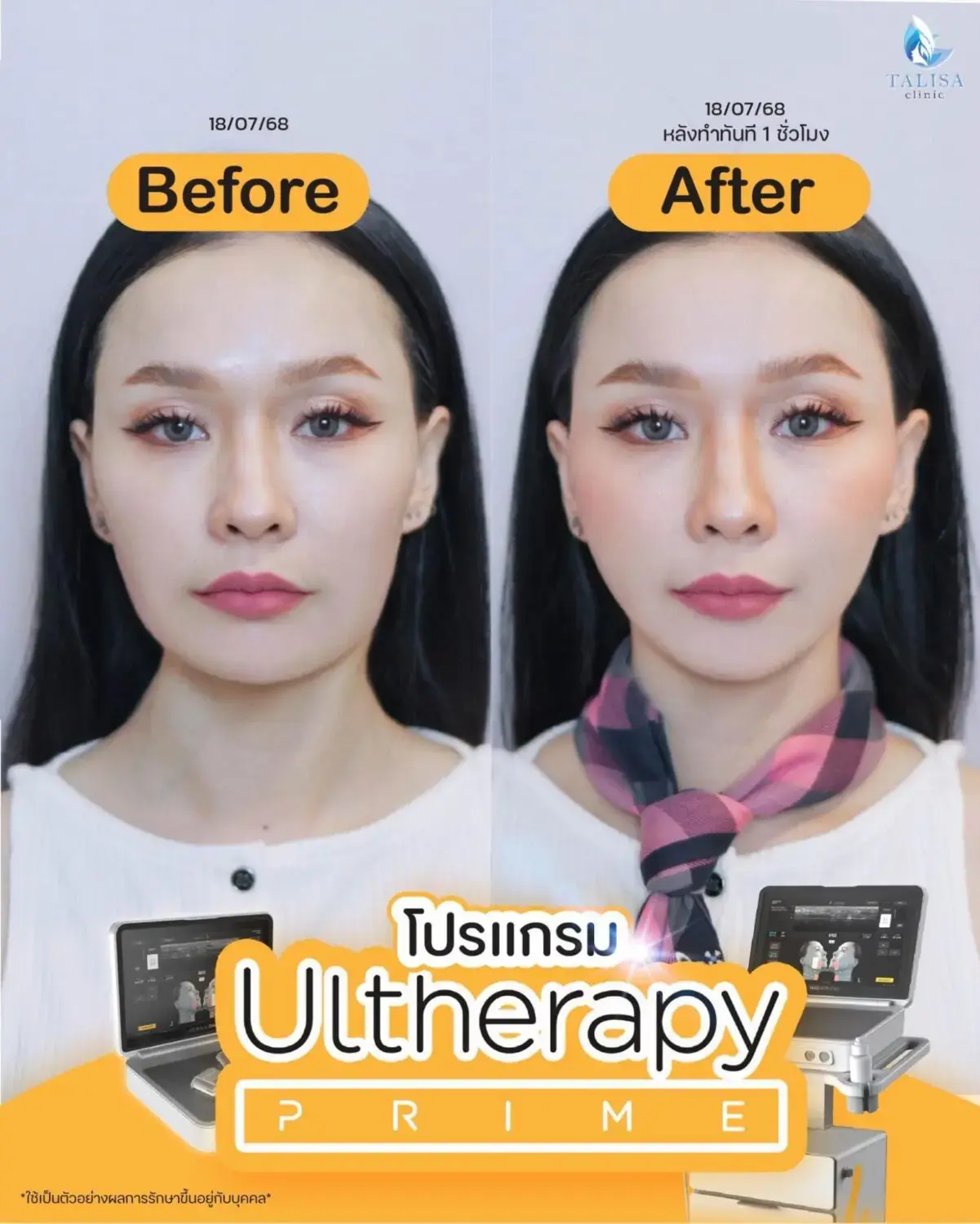 Ulthera Prime ผลลัพธ์