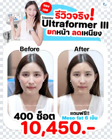 ก่อน-หลังทำ Ultraformer III รีวิว