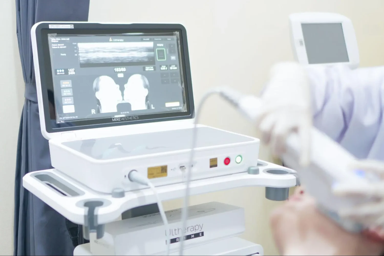 Ulthera SPT ต่างจากเครื่องอื่นไหม