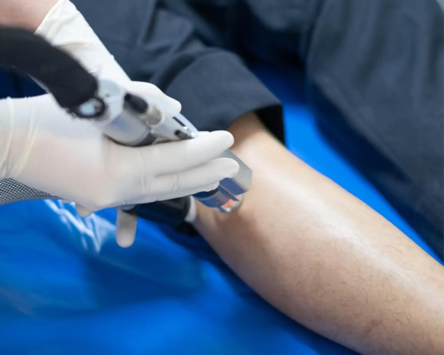 เลเซอร์ขนหน้ารักแร้