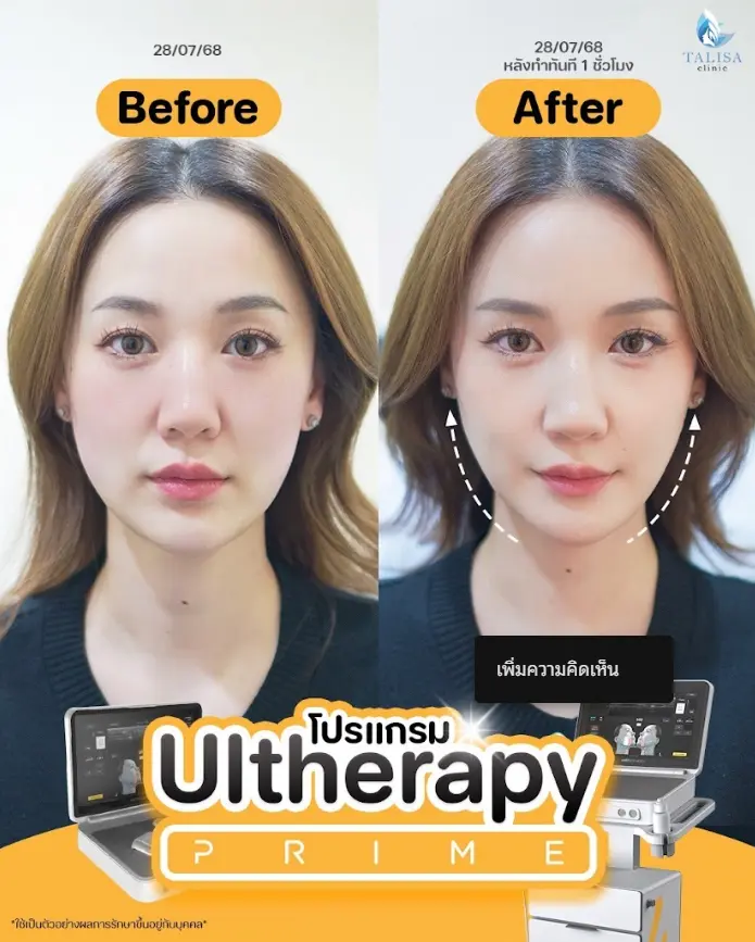 ulthera prime รีวิว