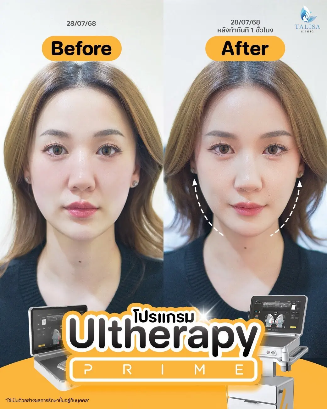 ulthera รีวิว