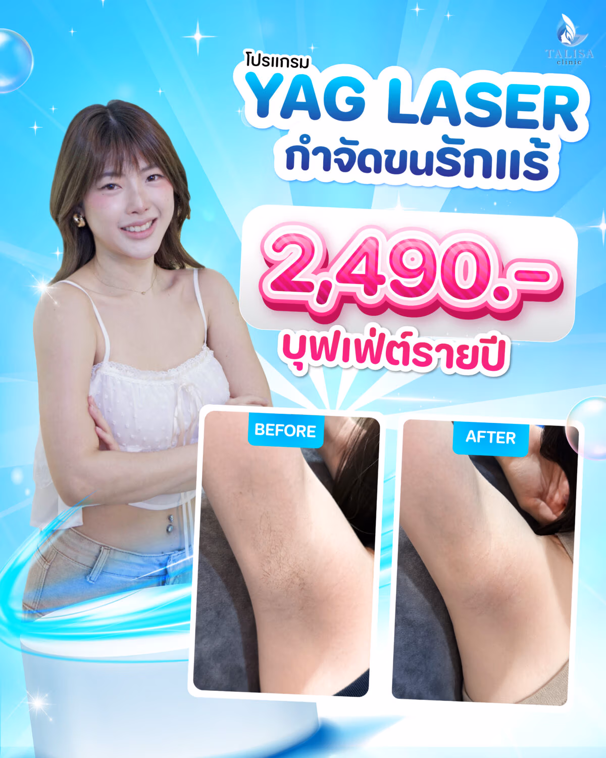 YAG Laser underarm hair removal annual buffet promotion for ฿2,490 at Talisa Clinic.